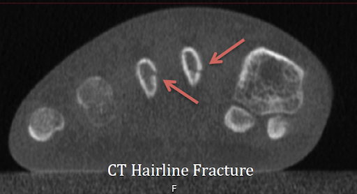 CT Hairline Fracture