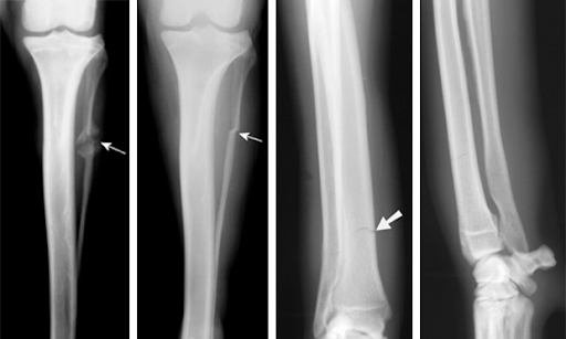 What is a Hairline Fracture?